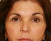 Feel Beautiful - Eyelid Surgery San Diego Case 46 - After Photo